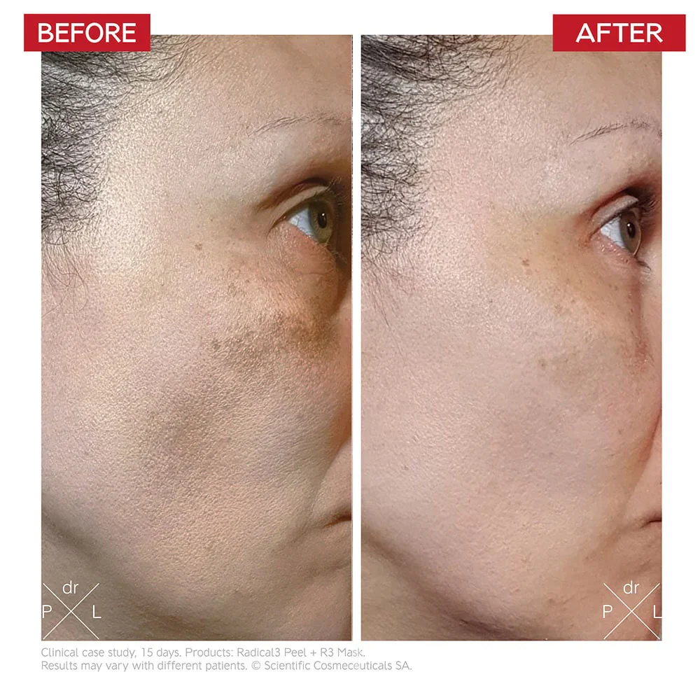 Dr. LEVY Switzerland Radical3 Reboot Pro Peel - Image 5