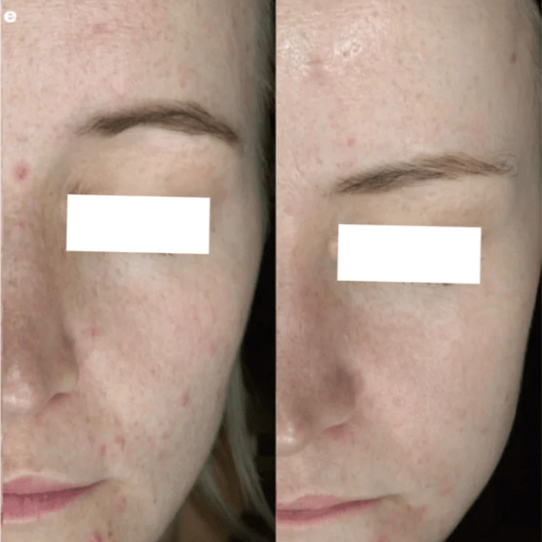 ZENii ProClear - Image 4